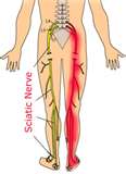 sciatica sciatic nerve pain relief treatment