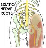 Sciatica sciatic nerve pain relief treatment