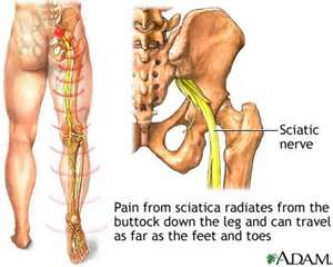 Sciatic nerve pain, numbness, and tingling sensation