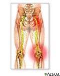 sciatica pain in the left buttock, right buttock, butt cheek, posterior pelvis, hips, and legs - sciatic nerve pain relief treatment